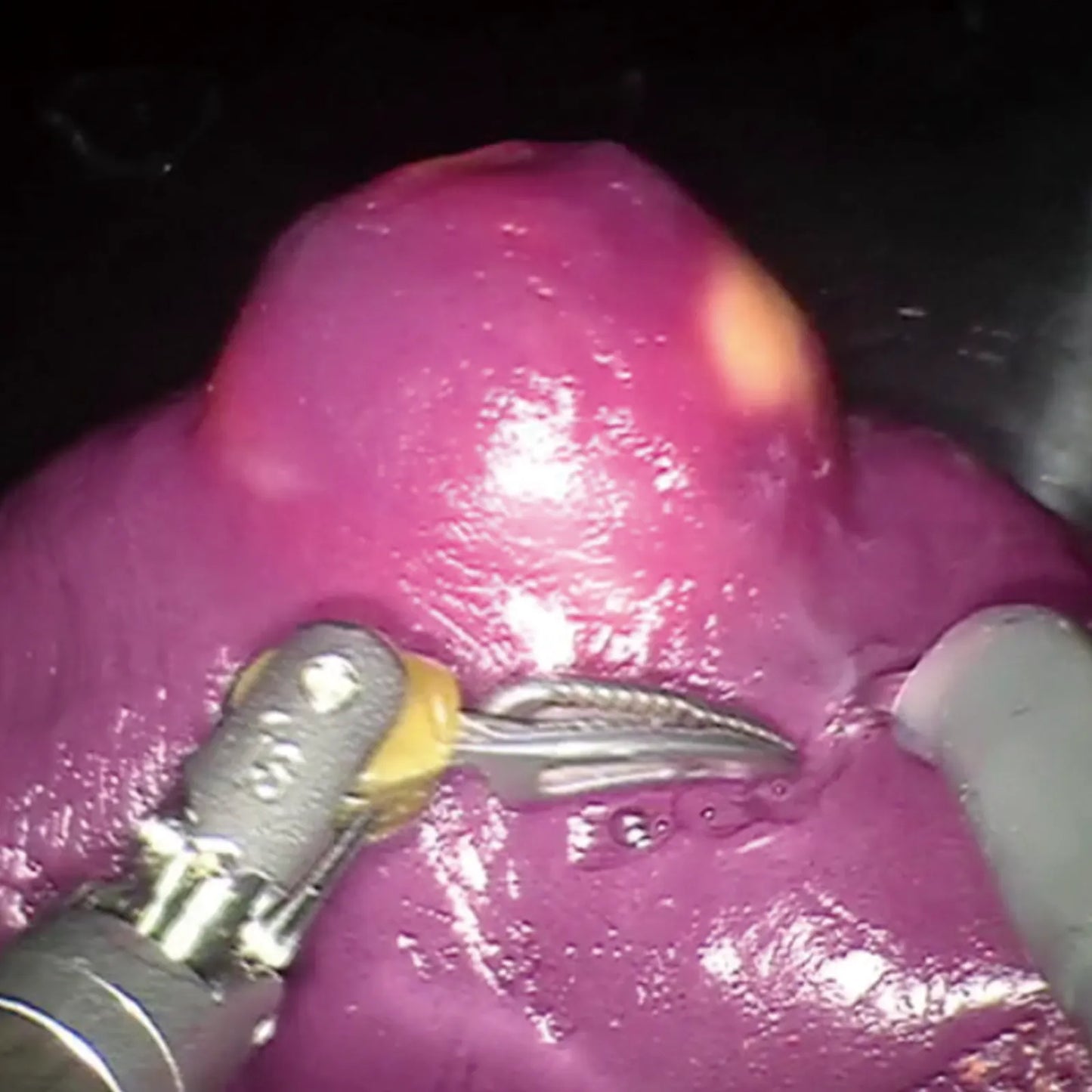 Partial Nephrectomy Model